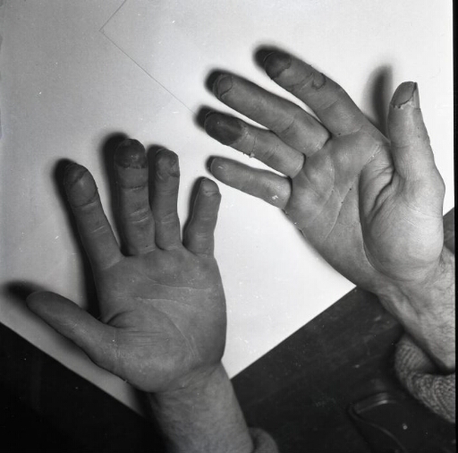 Les gelures aux doigts de l'intendant Georges Schwartz.